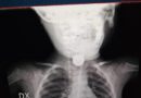 Ingerisce pila a disco, bimbo di due anni operato d’urgenza al Santobono. Ricoverato in terapia intensiva in prognosi riservata, ma non in pericolo di vita. Conenna: “Fenomeno in aumento, essenziale promuovere consapevolezza sui rischi”
