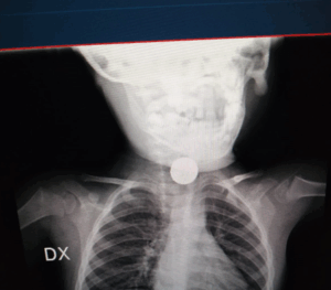radiografia pila incastrata